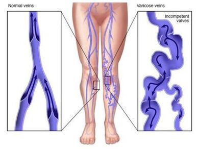 Neoveris previne deformarea venelor